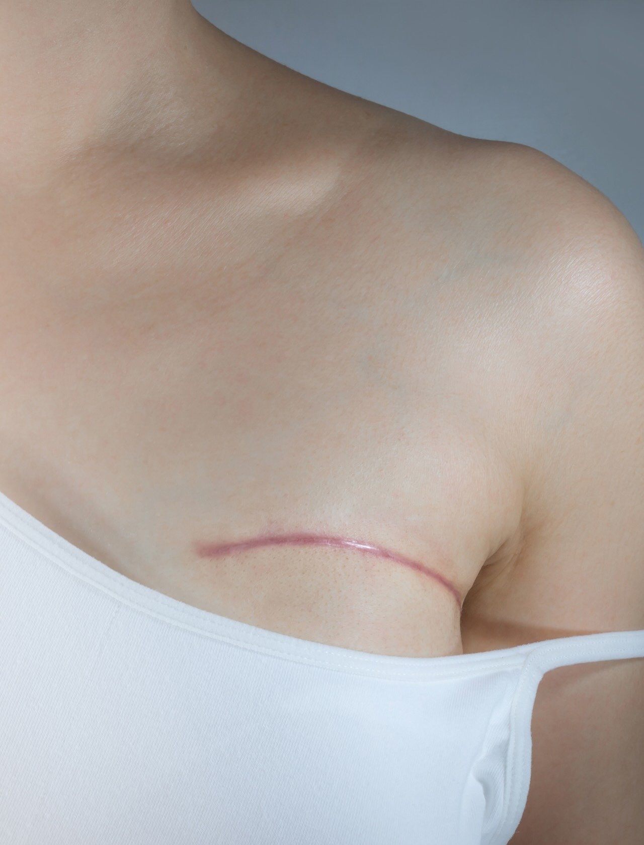 PRMA -  What is a Traditional Mastectomy_